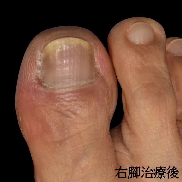 右腳治療後