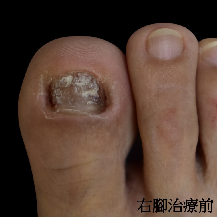 右腳治療前