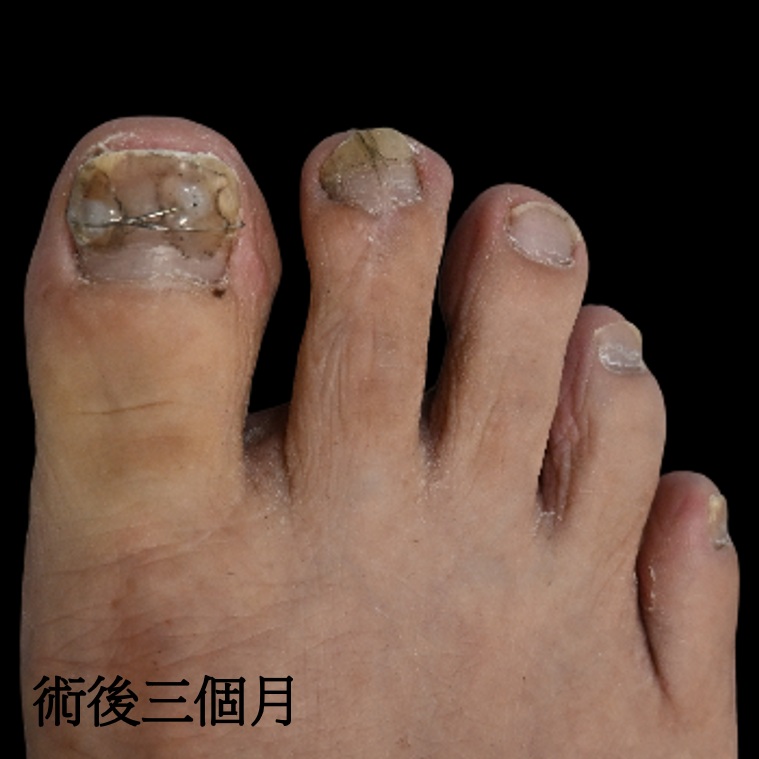 術後三個月