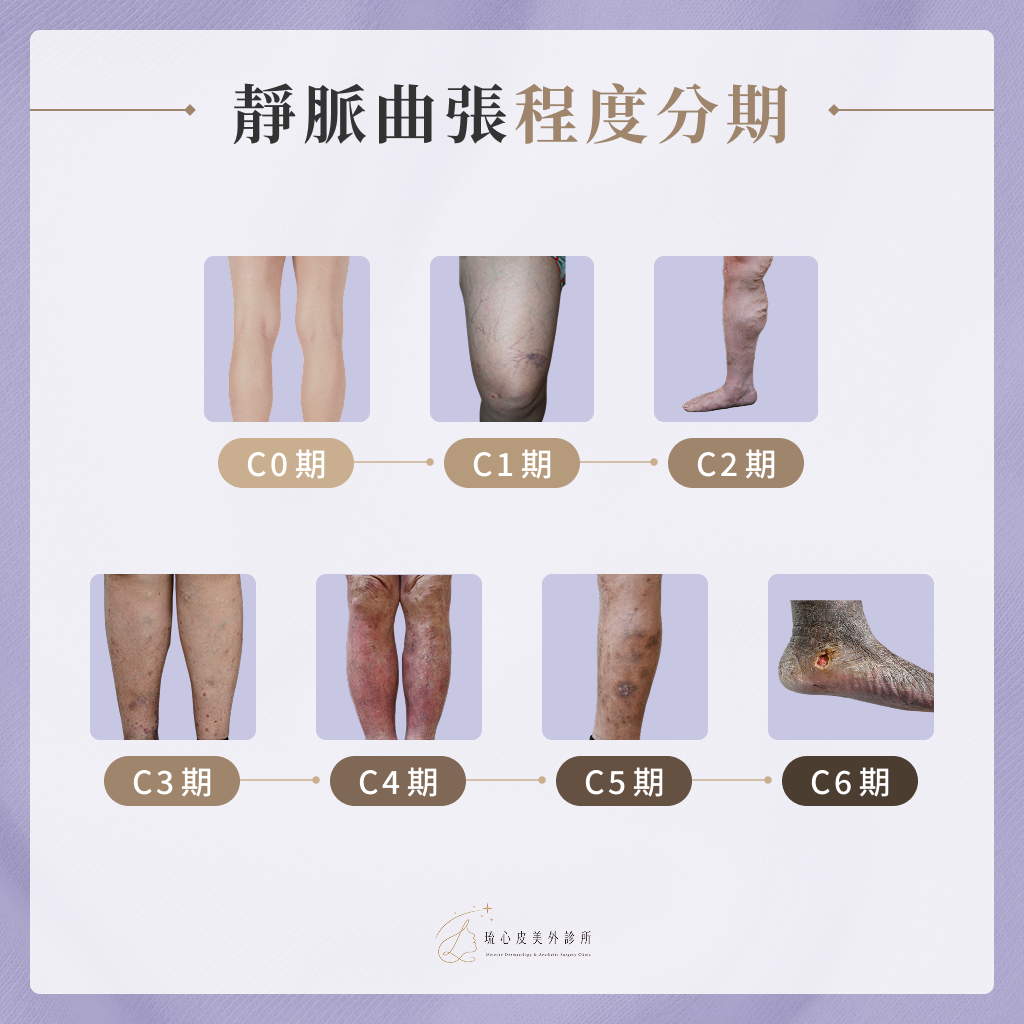 靜脈曲張程度分期 靜脈曲張程度分期