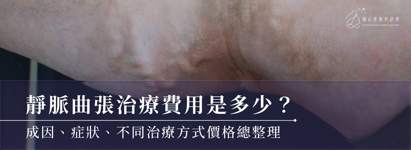 靜脈曲張治療費用是多少？成因、症狀、不同治療方式價格總整理