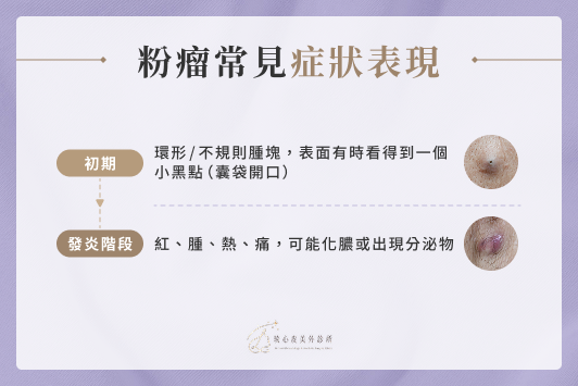 粉瘤常見症狀表現