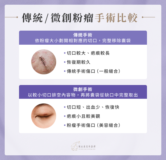 傳統／微創粉瘤手術比較