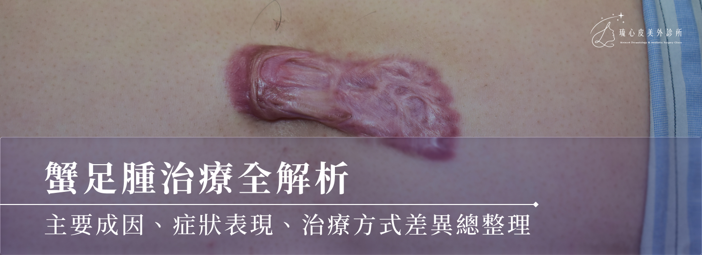 蟹足腫治療全解析：主要成因、症狀表現、治療方式差異總整理