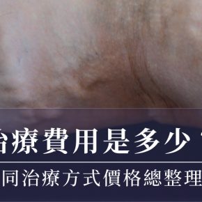 靜脈曲張治療費用是多少？成因、症狀、不同治療方式價格總整理