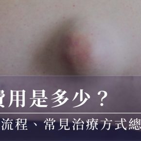 粉瘤手術費用是多少？手術類型、基本流程、常見治療方式總整理