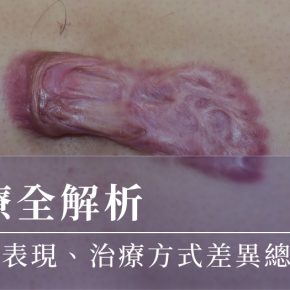 蟹足腫治療全解析：主要成因、症狀表現、治療方式差異總整理