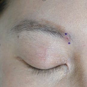 眉毛術前粉瘤
